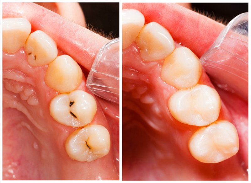 Fillings Edwardsville, IL 