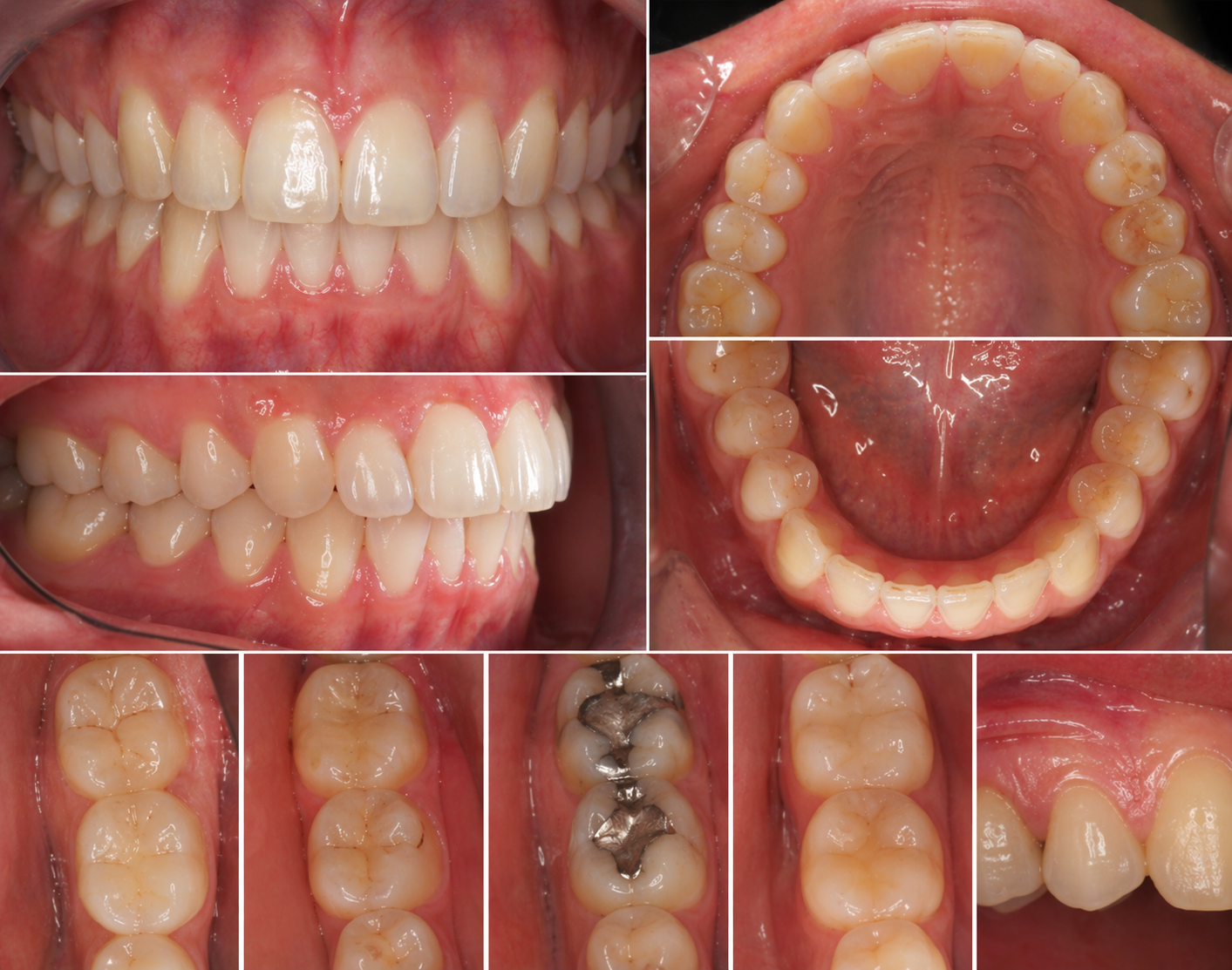 Intraoral Cameras